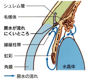 開放隅角緑内障