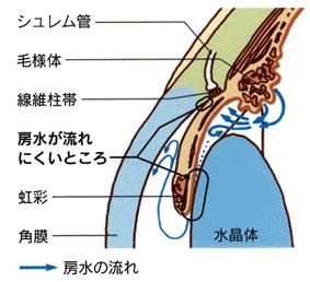 閉塞隅角緑内障