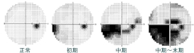 視野の欠け方イメージ図